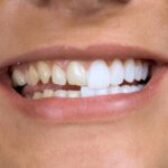 کامپوزیت دندان و ترمیم لب پریدگی دندان های جلو
