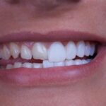 آیا لمینت دندان درد دارد؟